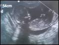 3_mo_ultrasound